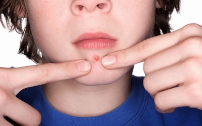 acne pimple