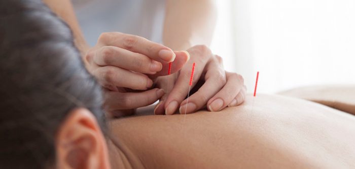 acupuncture