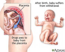 Source: Monterey Bay Holistic Alliance baby-drug-withdrawl
