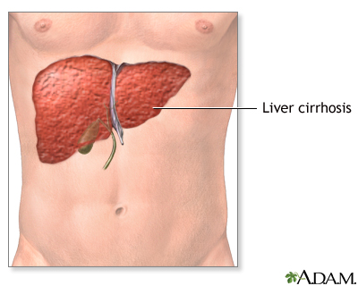 cirrhosis