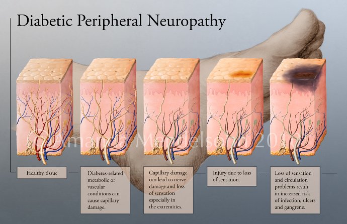 What are the symptoms of neuropathy in the legs?