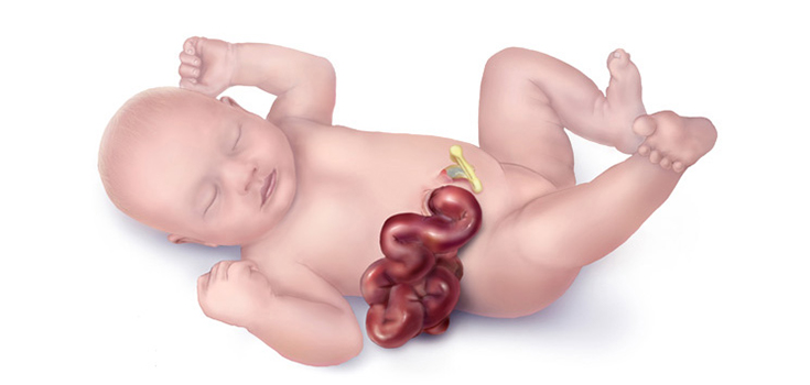 image-gastroschisis-web-735-350