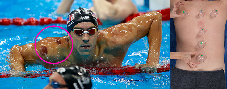 image-landscape-michael-phelps-cupping-735-290