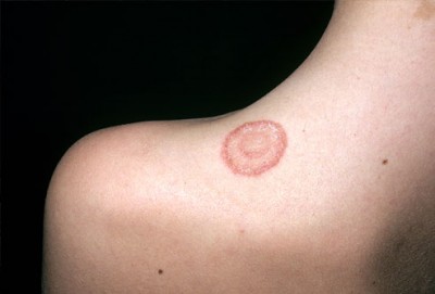 ringworm