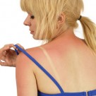 Home Remedies for Sunburn – 4 Natural Solutions Home Remedies for Sunburn – 4 Natural Solutions