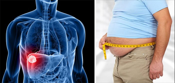 obesity and liver cancer
