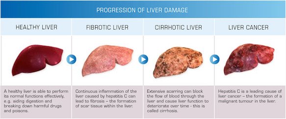 1_progression-of-liver-damage