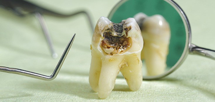 Plaque on Teeth Could Contribute to Premature Cancer Death