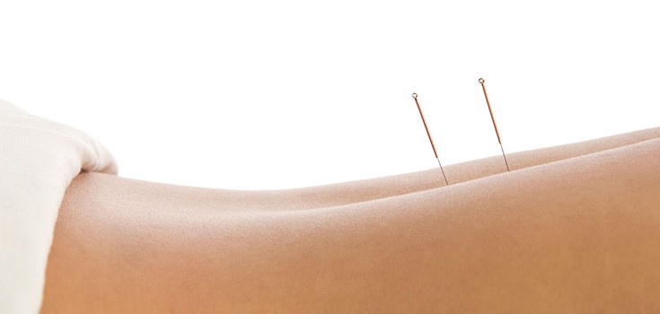 back acupuncture