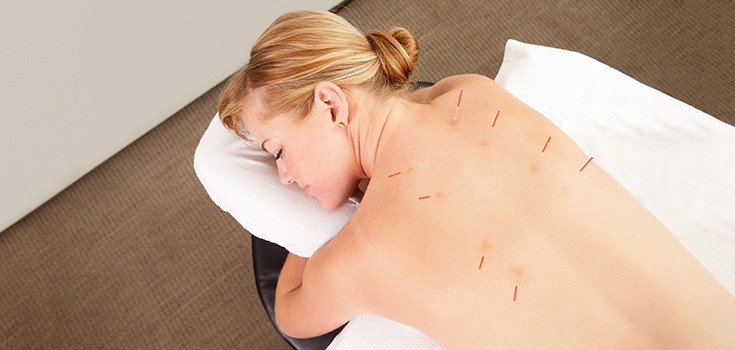Study Involving 18,000 People Confirms Acupuncture for Pain a Truly Effective Solution