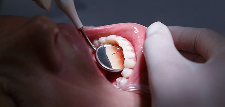 European Commission Recommends Banning Mercury Fillings