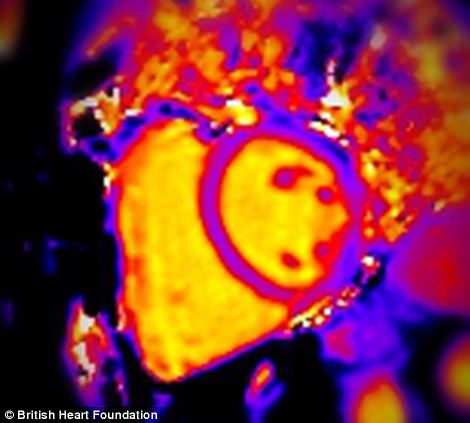 MRI of the heart of a healthy kidney donor.