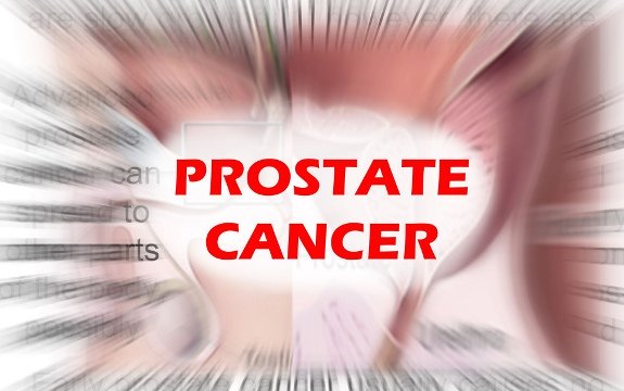 PSA Creator: PSA Test for Prostate Cancer is Problematic