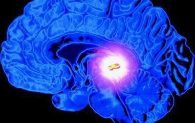 New Insight: Alzheimer’s Disease Linked to Pineal Gland Calcification from Fluoride