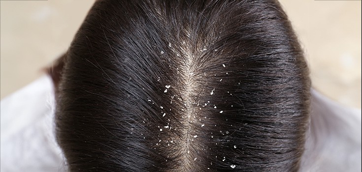 9 Home Remedies for Dandruff – How to Get Rid of Dandruff Naturally