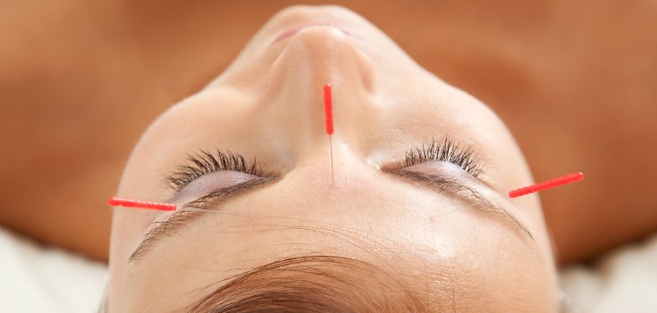 3 Interesting Ways Acupuncture can Help with Chronic Pain and PTSD