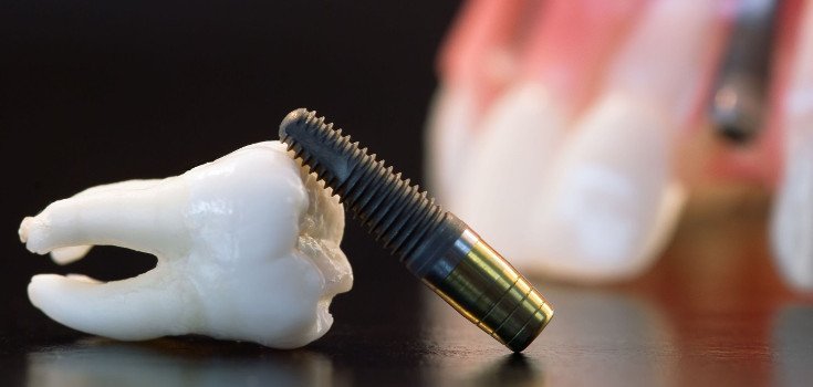 How Root Canals Could Spark Autoimmune Diseases