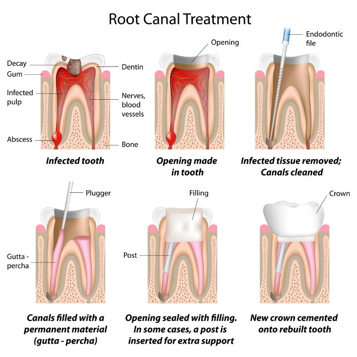 teeth_root_canal_chart_730