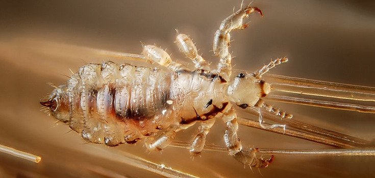Drug-Resistant Head Lice Found in 25 States