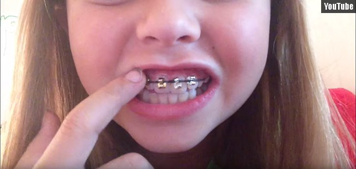 Orthodontists Warn Against DIY Braces Fad to Straighten Your own Teeth