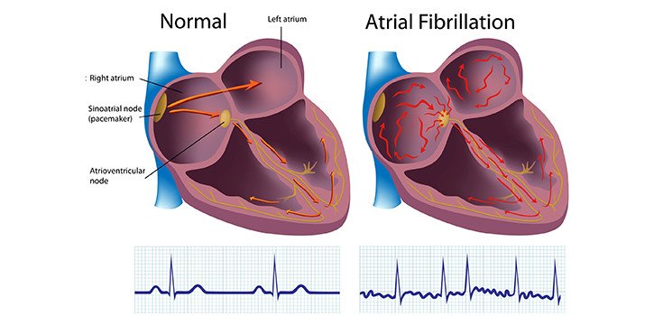 Know the Causes and Symptoms of Atrial Fibrillation