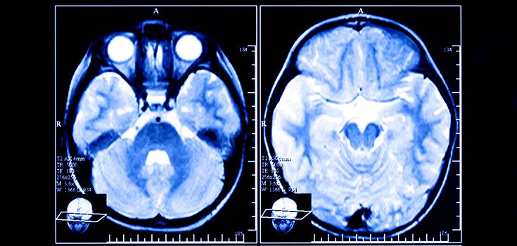 Brain Scans may Predict Depression Relapse