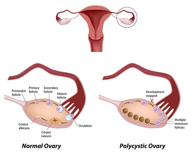 ovarian-polyctstic-650