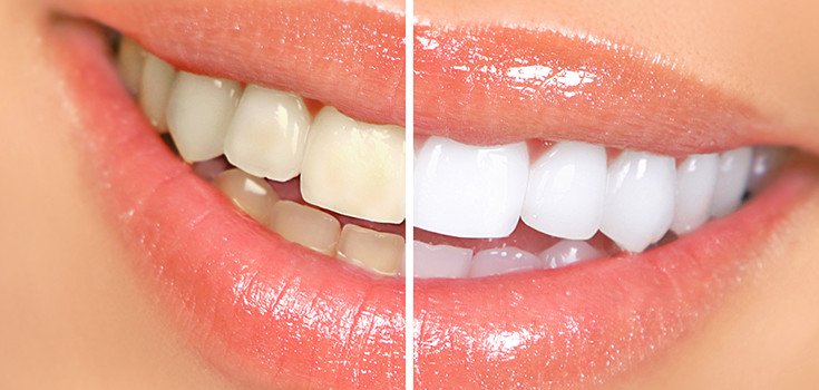 For a Beautiful Smile: 7 Natural Teeth Whitening Home Remedies