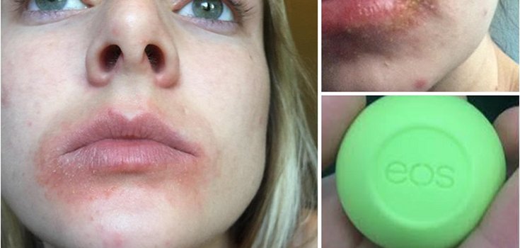 Lawsuit: Here’s Why People are Complaining About This Popular Lip Balm