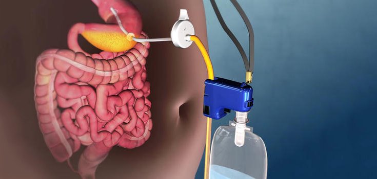 FDA Approves Stomach Pump Device for Weight Loss