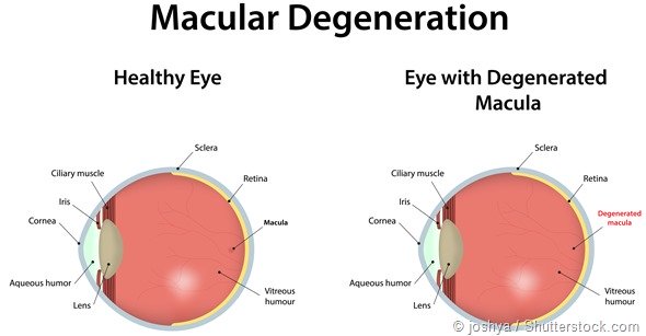 image-macular-degenretaion