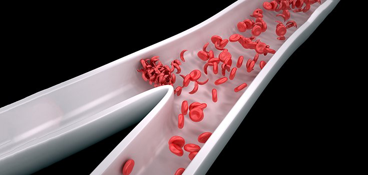 Having a Sickle Cell Trait May NOT Increase Risk of Premature Death