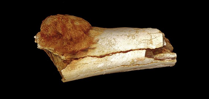 Evidence of Human Cancer 1.7 Million Years Ago Discovered