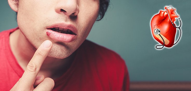 Could ‘Benign’ Cold Sores be Harming Your Heart?