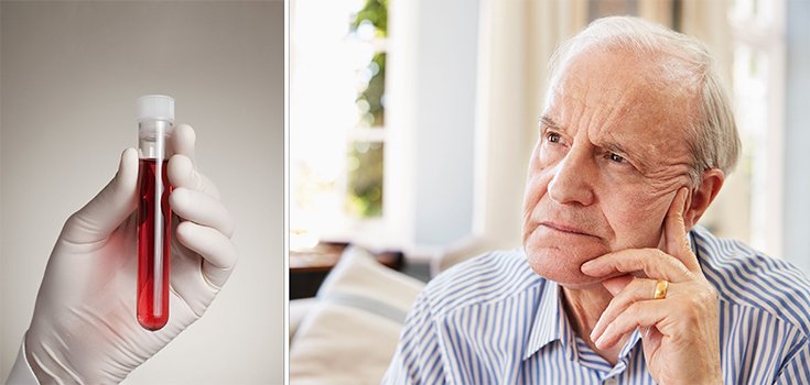 Blood Test Could Predict Alzheimer’s More than 16 Years Before Onset