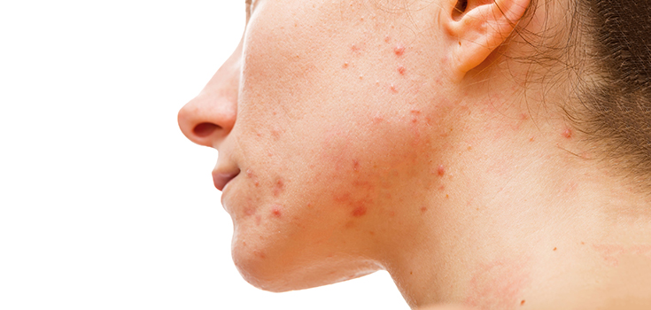 acne
