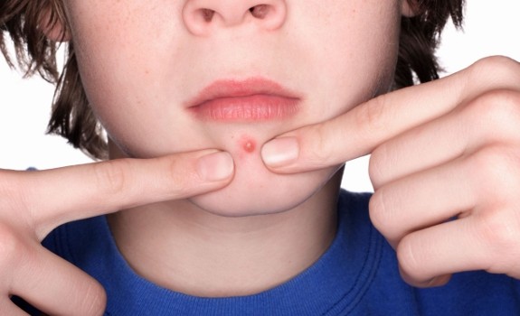 acne pimple