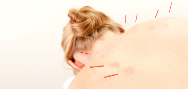 acupuncture for pain