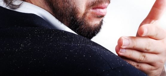 dandruff