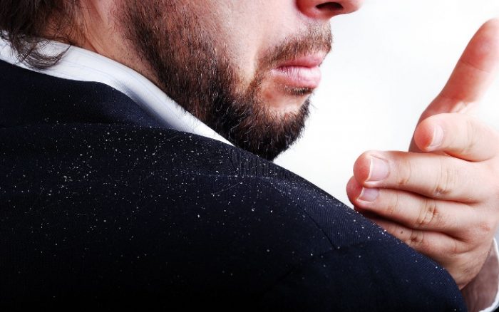 dandruff