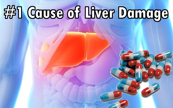 Beware The 1 Cause of Acute Liver Damage is Acetaminophen