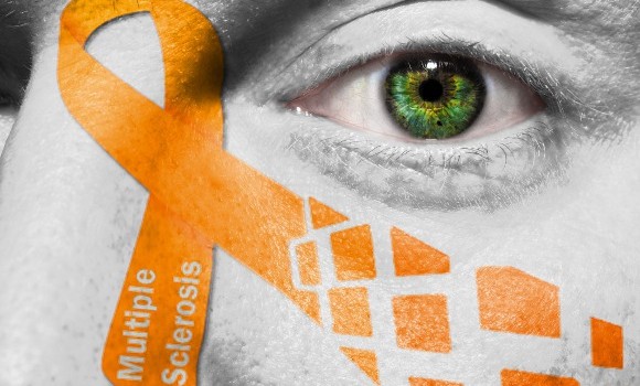 multiple sclerosis